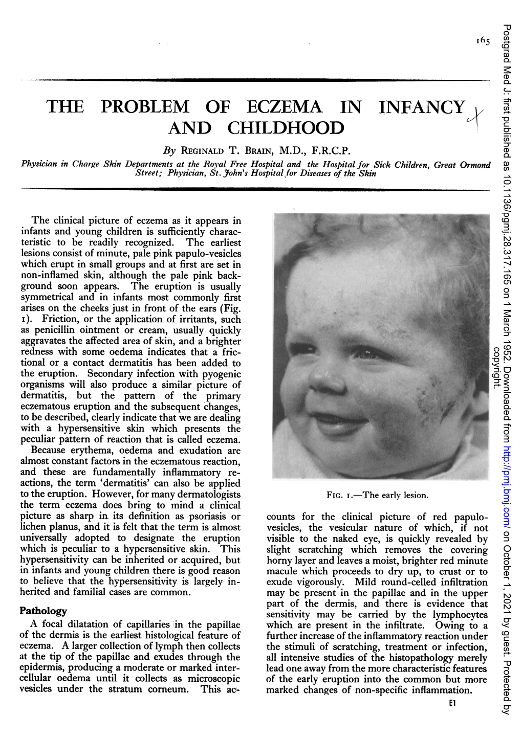 THE PROBLEM of ECZEMA in INFANCY and CHILDHOOD by REGINALD T