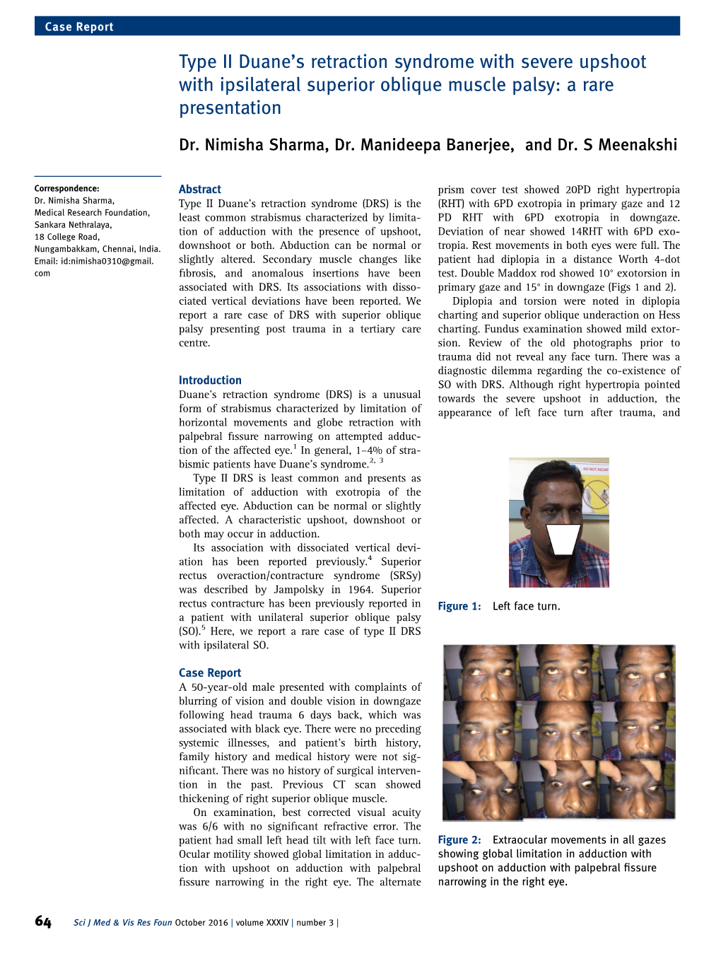 Type II Duaneis Retraction Syndrome with Severe