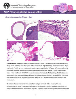 Ovary, Paraovarian Tissue – Cyst