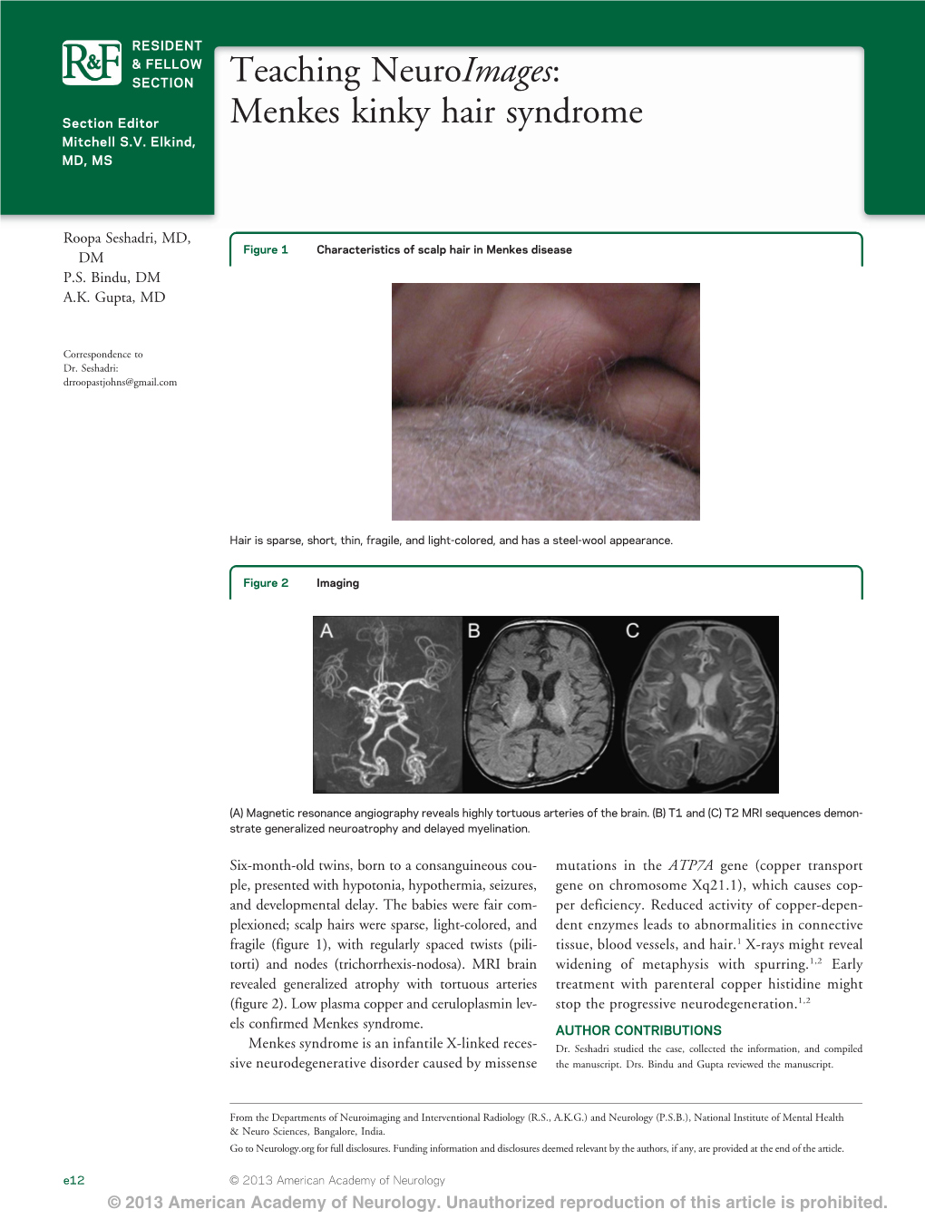 Teaching Neuroimages: Menkes Kinky Hair Syndrome Roopa Seshadri, P.S