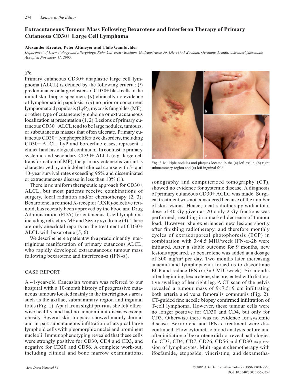 Extracutaneous Tumour Mass Following Bexarotene and Interferon Therapy of Primary Cutaneous CD30+ Large Cell Lymphoma