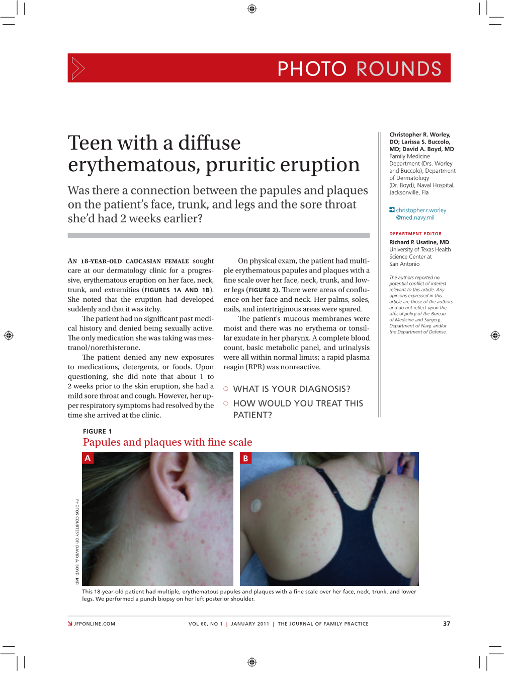 Teen with a Diffuse Erythematous, Pruritic Eruption