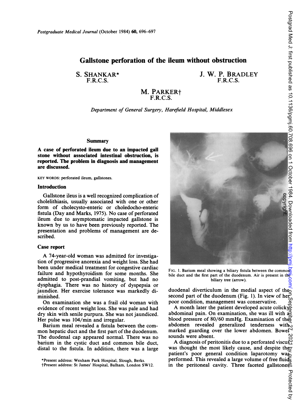 Gallstone Perforation of the Ileum Without Obstruction M. Parkert