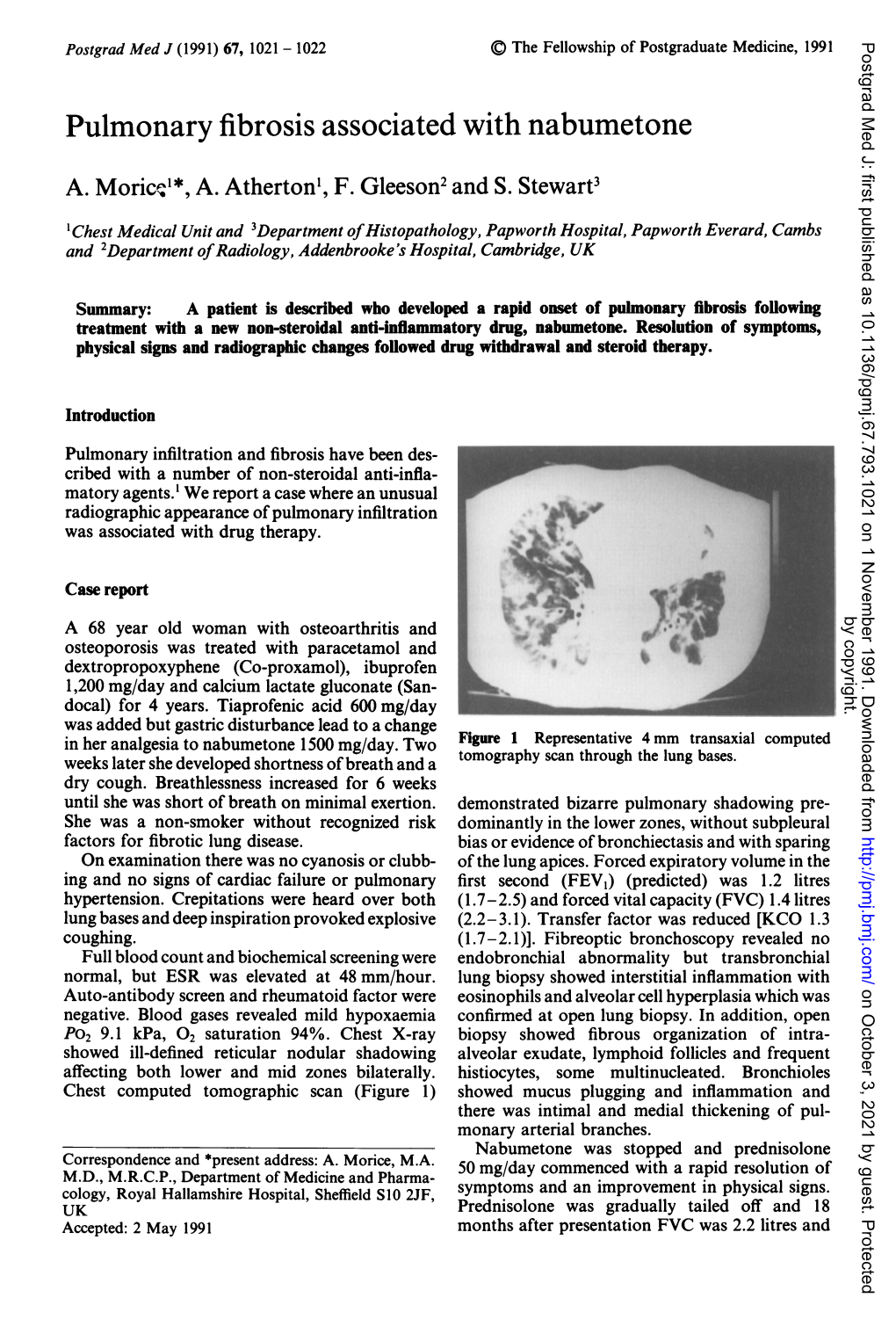 Pulmonary Fibrosis Associated with Nabumetone A