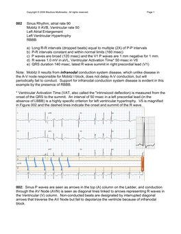 002 Sinus Rhythm, Atrial Rate 90 Mobitz II AVB, Ventricular Rate 50 Left Atrial Enlargement Left Ventricular Hypertrophy RBBB