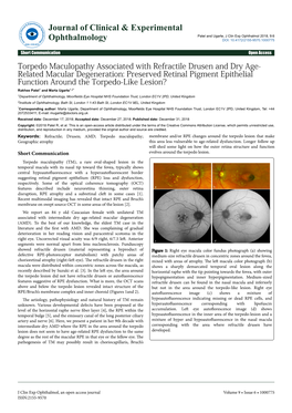 Torpedo Maculopathy Associated with Refractile Drusen and Dry Age-Related Macular Degeneration