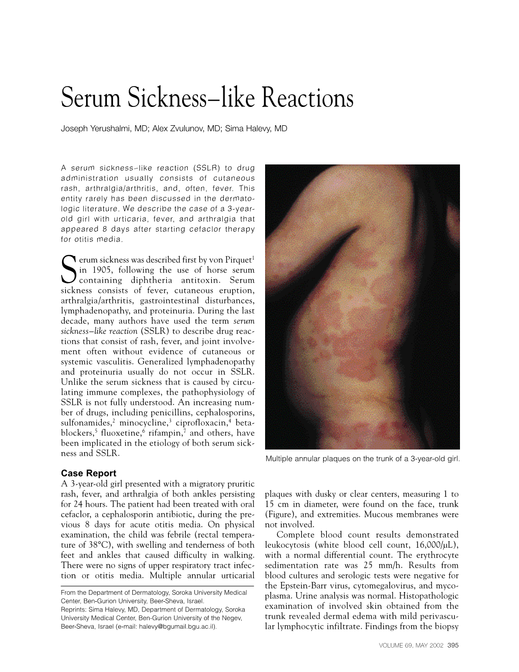 Serum Sickness–Like Reactions