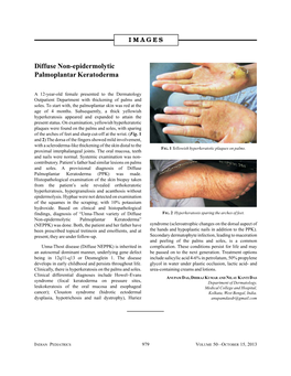 Diffuse Non-Epidermolytic Palmoplantar Keratoderma