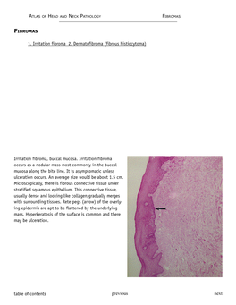 1. Irritation Fibroma 2. Dermatofibroma (Fibrous Histiocytoma)