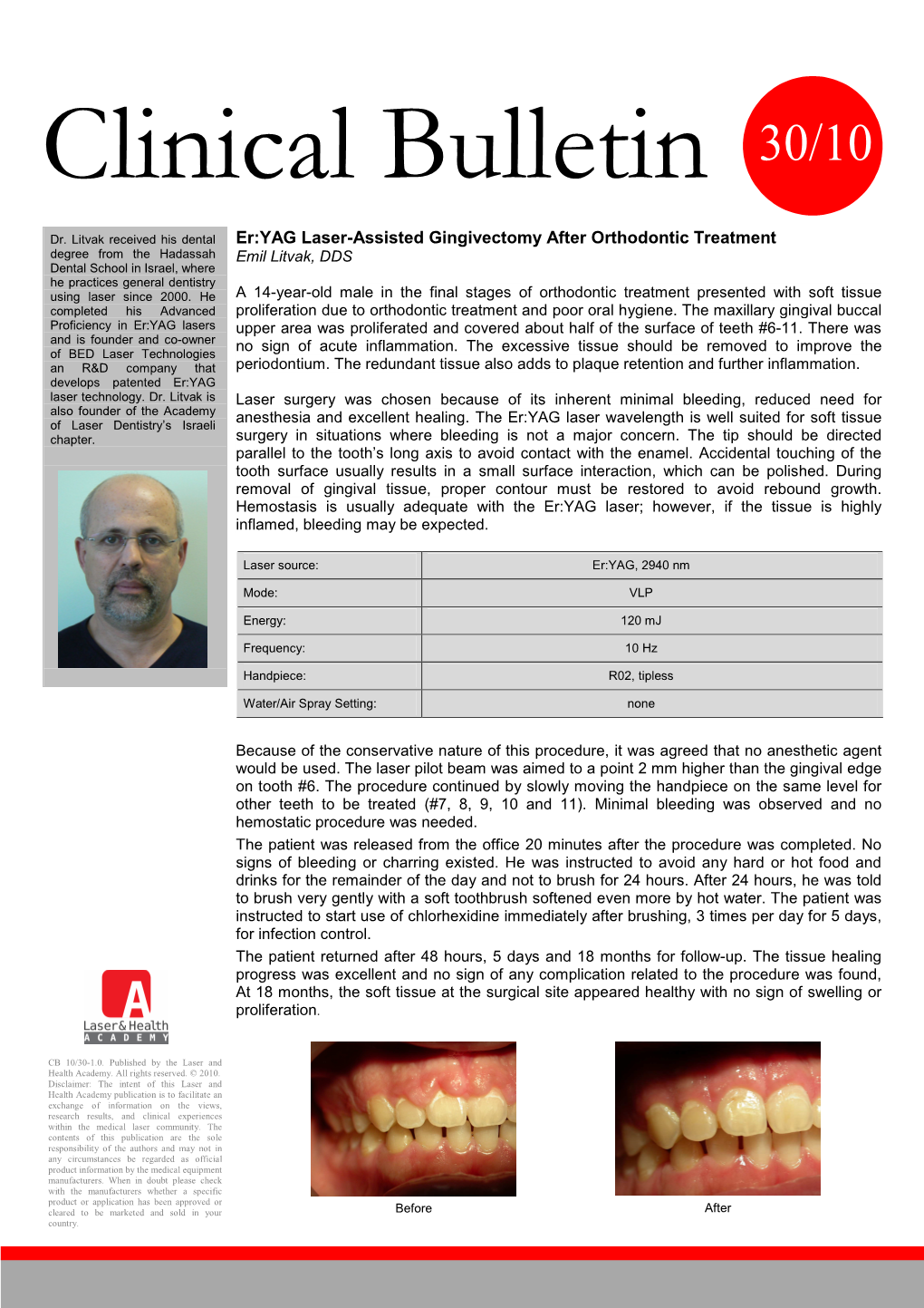 Er:YAG Laser-Assisted Gingivectomy After Orthodontic Treatment