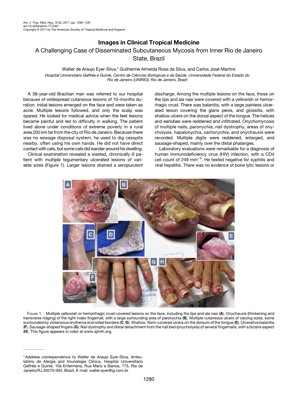 Images in Clinical Tropical Medicine a Challenging Case of Disseminated Subcutaneous Mycosis from Inner Rio De Janeiro State, Brazil