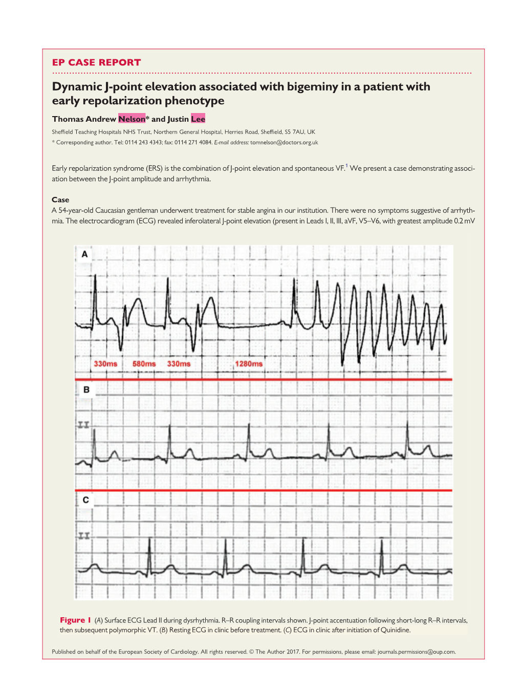 Dynamic J-Point Elevation Associated