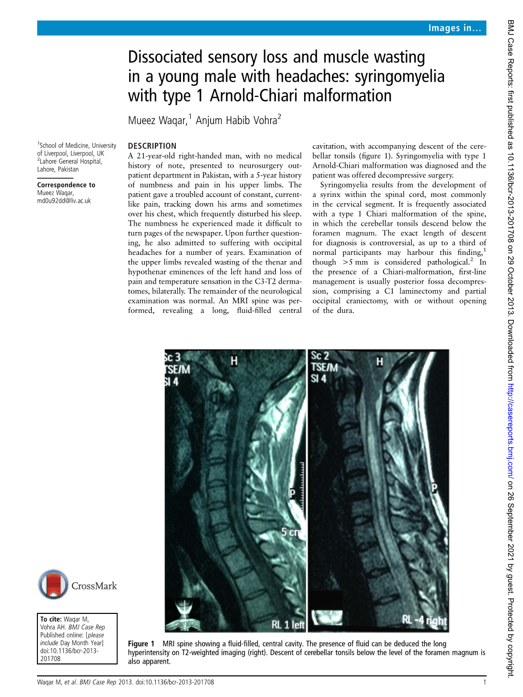 Syringomyelia with Type 1 Arnold-Chiari Malformation Mueez Waqar,1 Anjum Habib Vohra2