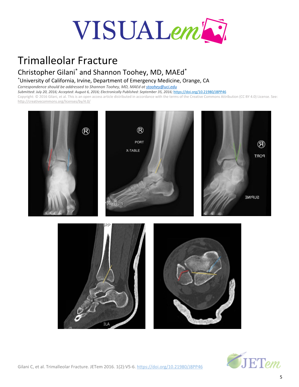 Trimalleolar Fracture