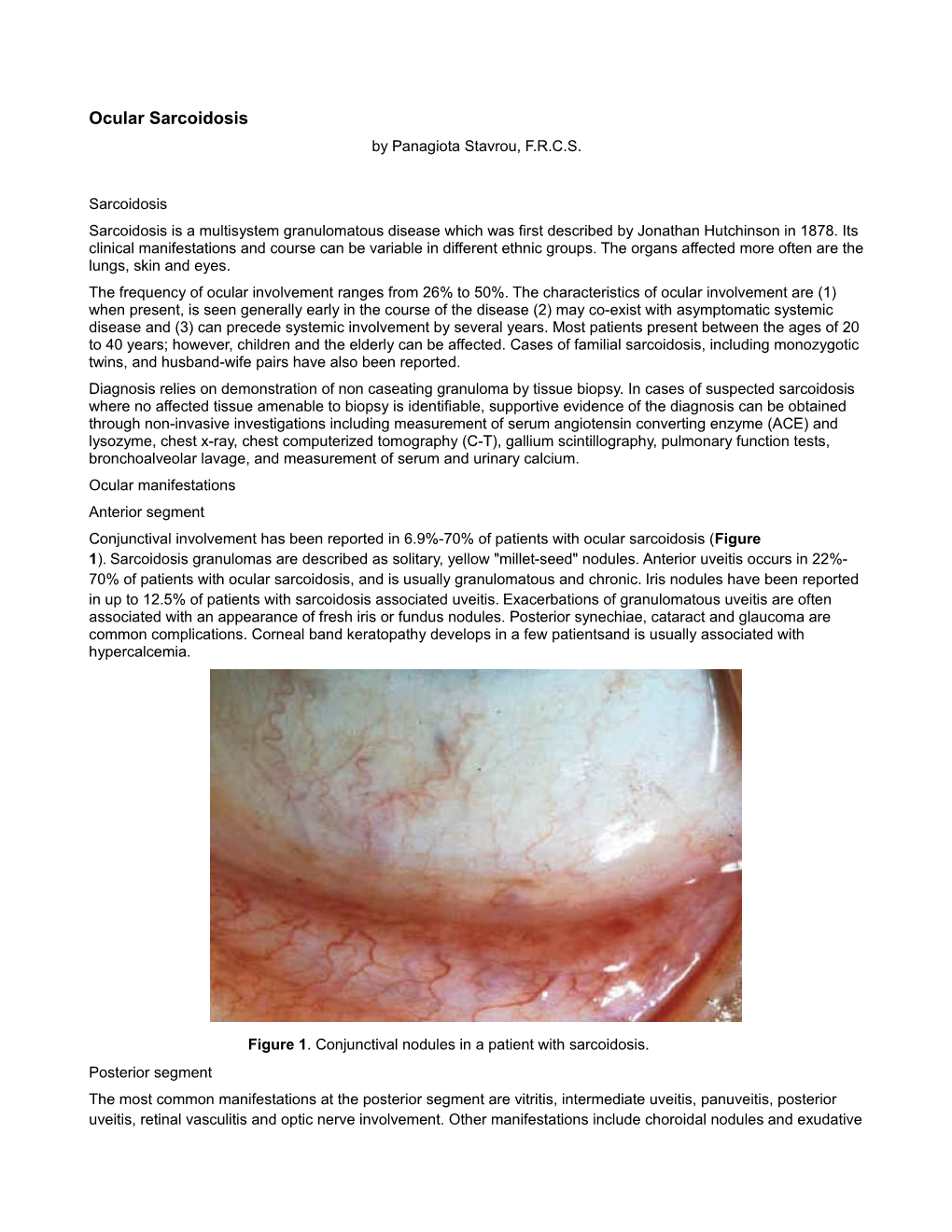 Ocular Sarcoidosis by Panagiota Stavrou, F.R.C.S