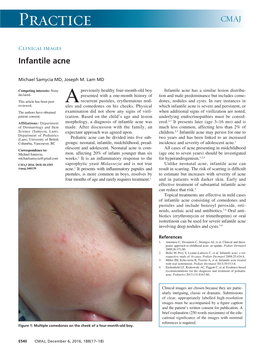 Infantile Acne