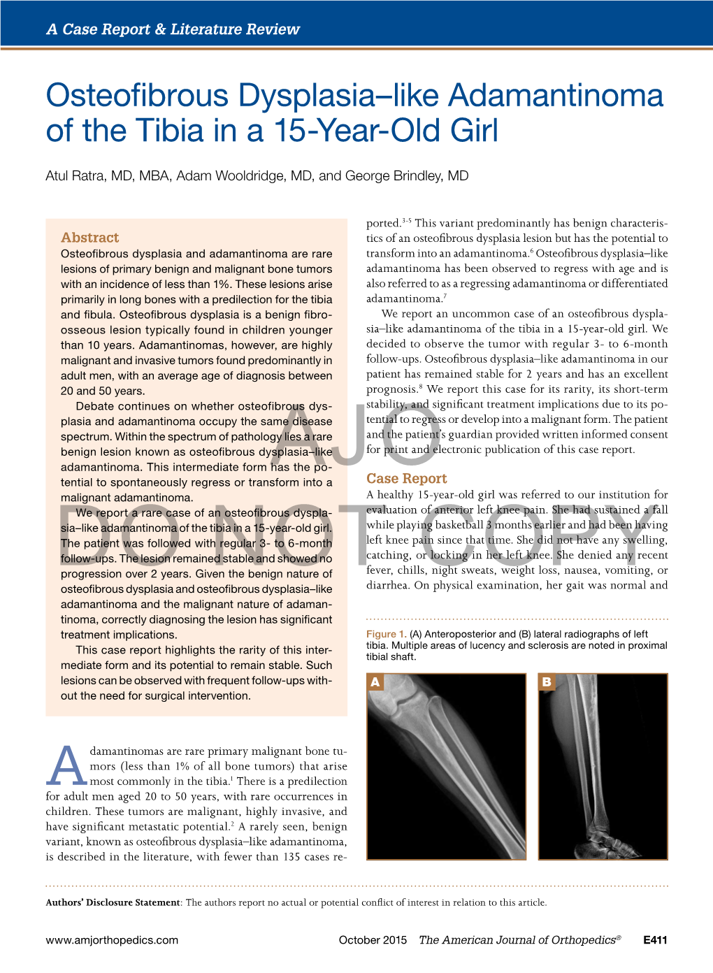 Osteofibrous Dysplasia–Like Adamantinoma of the Tibia in a 15-Year-Old Girl