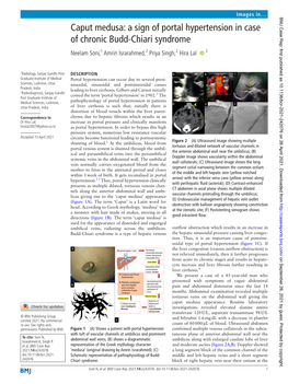 Caput Medusa: a Sign of Portal Hypertension in Case of Chronic Budd-Chiari Syndrome