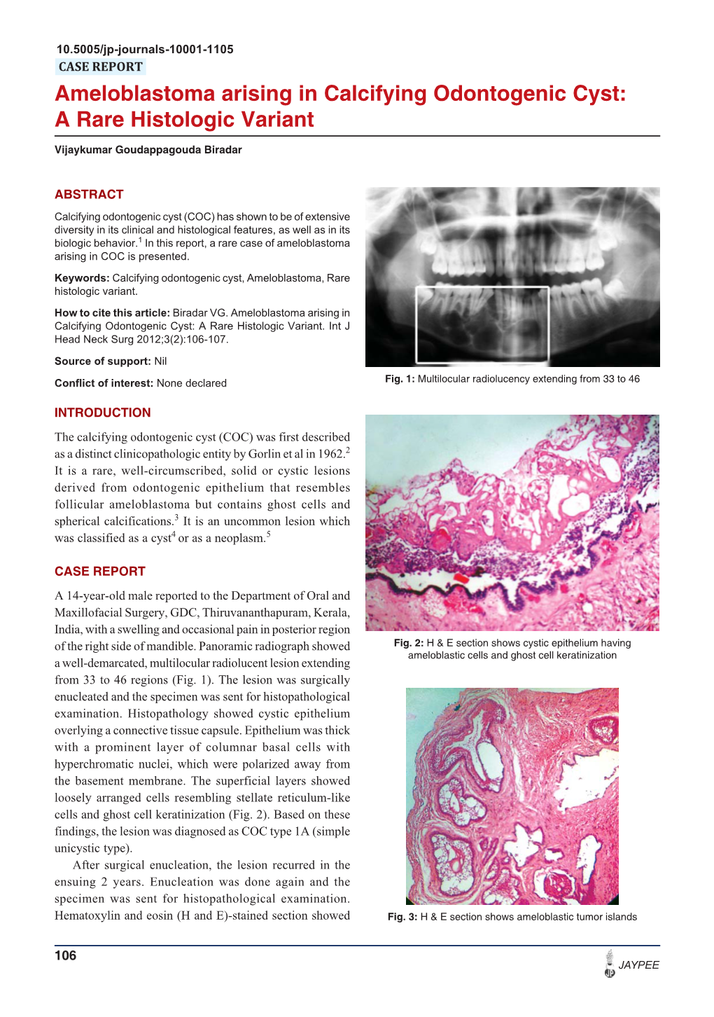 Ameloblastoma Arising in Calcifying Odontogenic Cyst: a Rare Histologic Variant