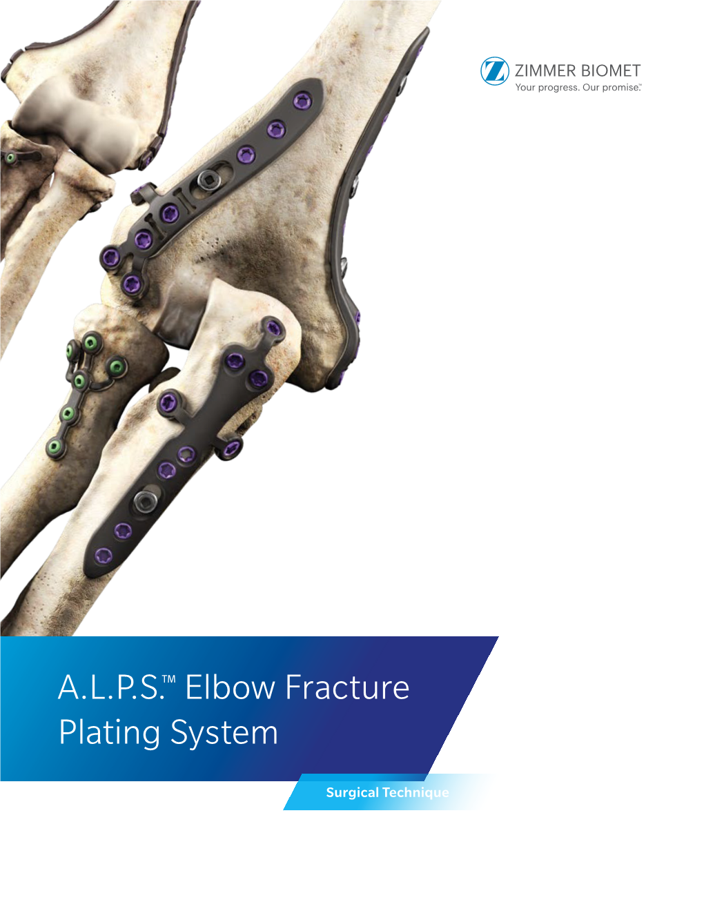 A.L.P.S.™ Elbow Fracture Plating System Surgical Technique