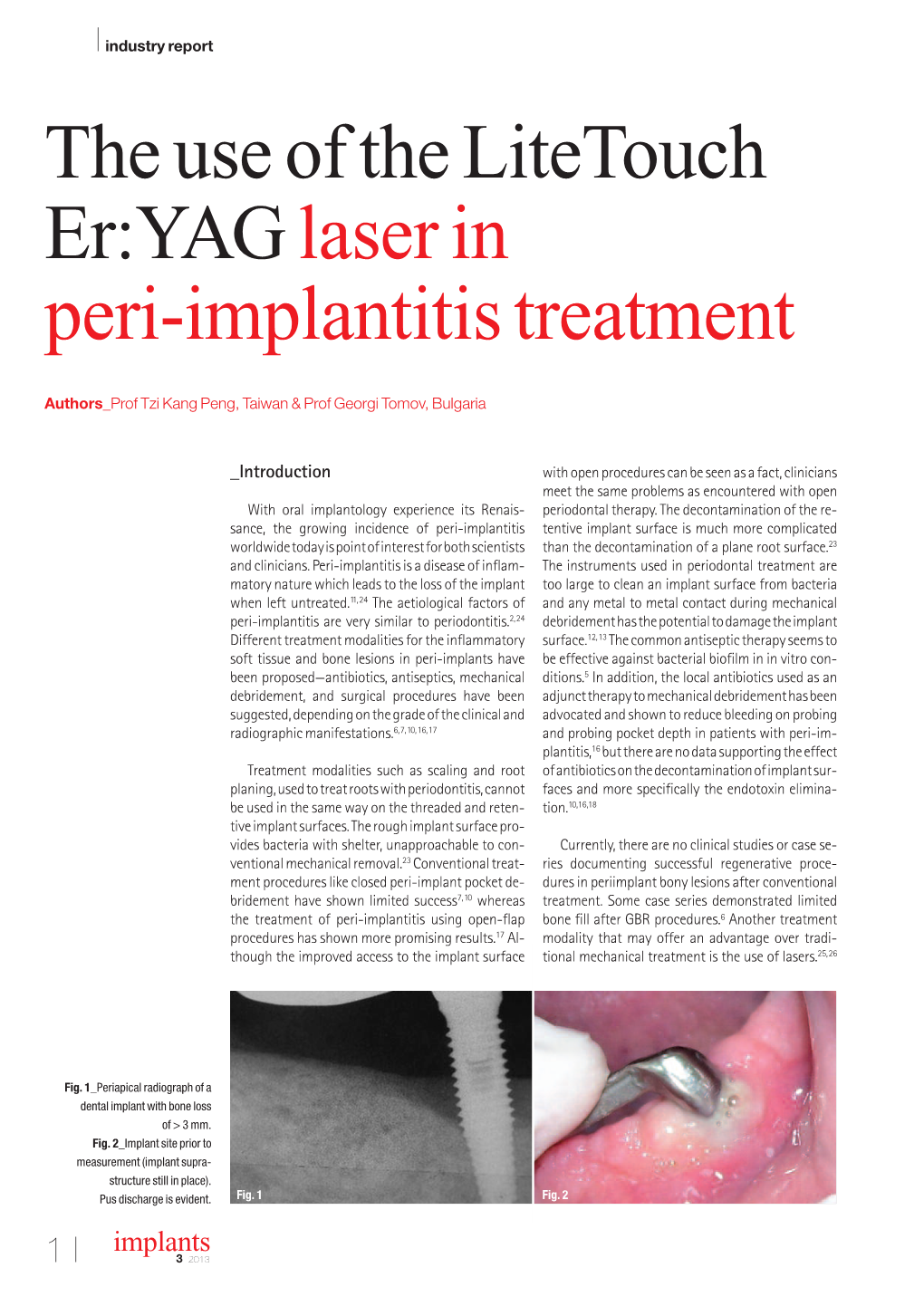 The Use of the Litetouch Er:YAG Laser in Peri-Implantitis Treatment
