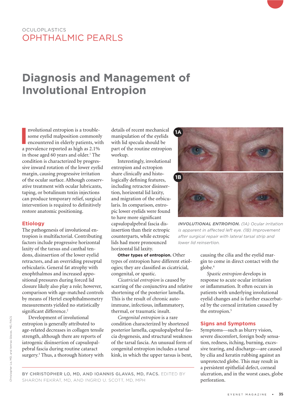 Diagnosis and Management of Involutional Entropion