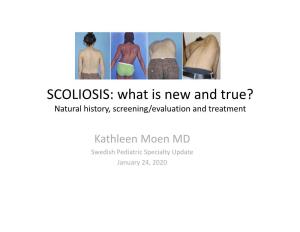 SCOLIOSIS: What Is New and True? Natural History, Screening/Evaluation and Treatment
