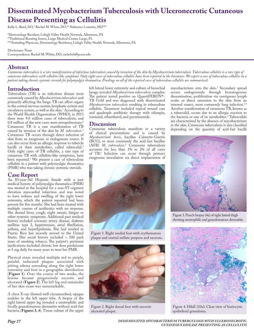 Disseminated Mycobacterium Tuberculosis with Ulceronecrotic Cutaneous Disease Presenting As Cellulitis Kelly L