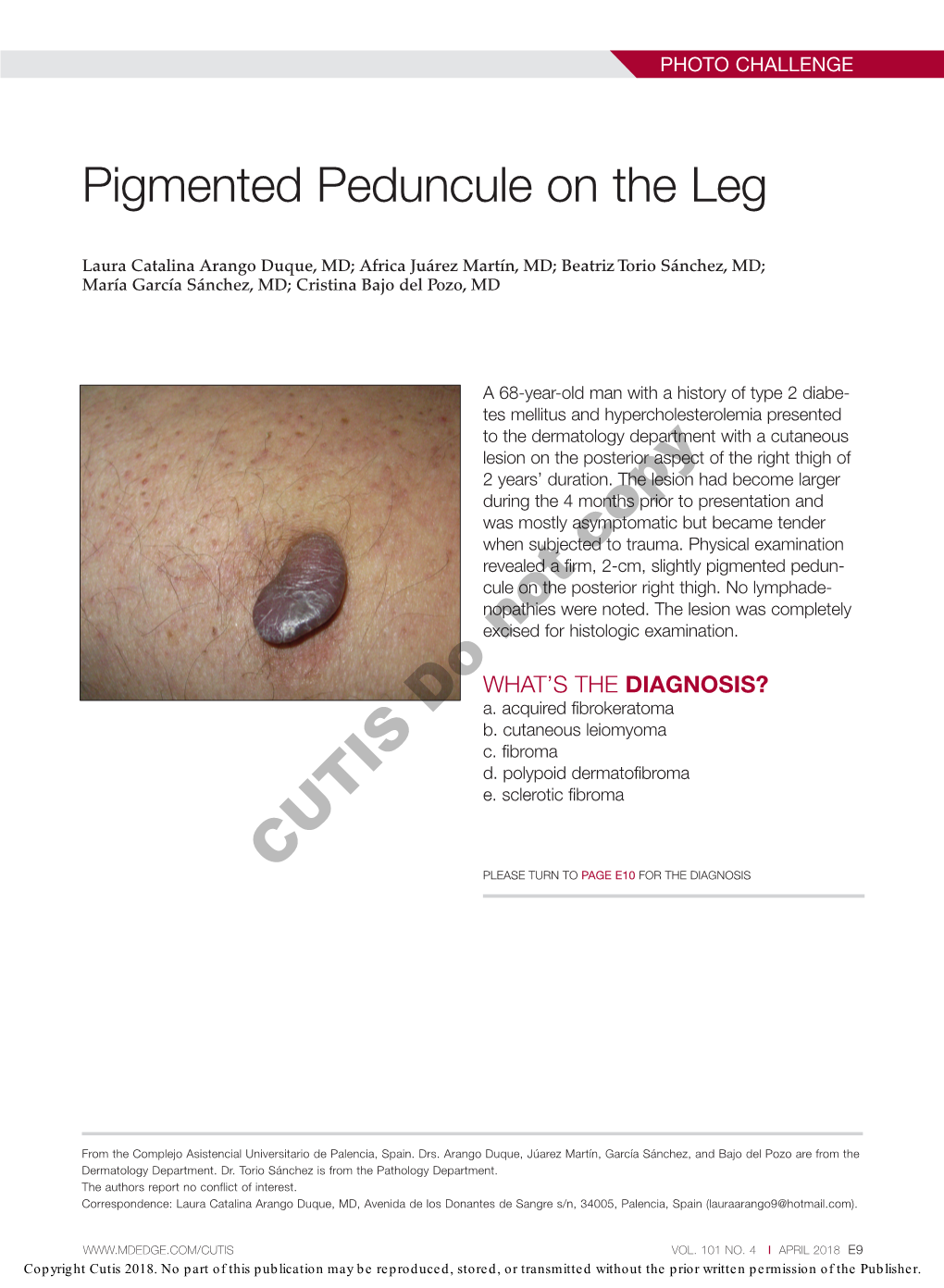 Pigmented Peduncule on the Leg