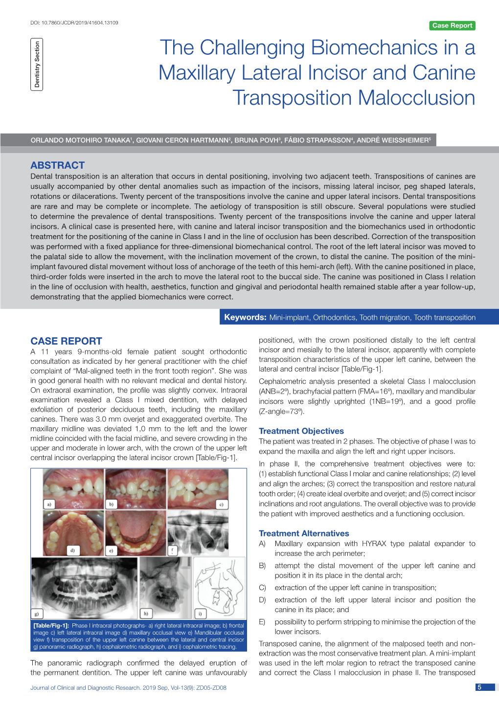 The Challenging Biomechanics in a Maxillary Lateral Incisor and Canine Transposition Malocclusion