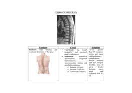 THORACIC SPINE PAIN Condition Causes Symptoms Scoliosis