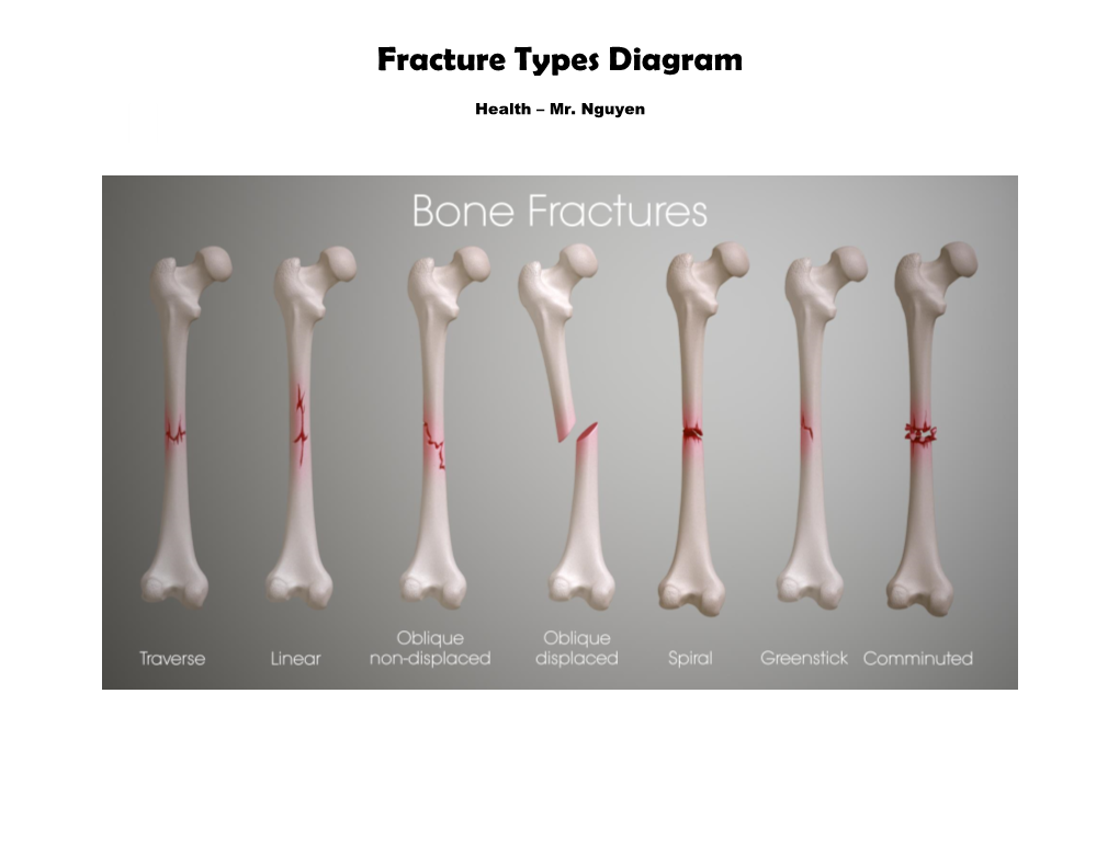 Fracture Types Diagram - Docslib