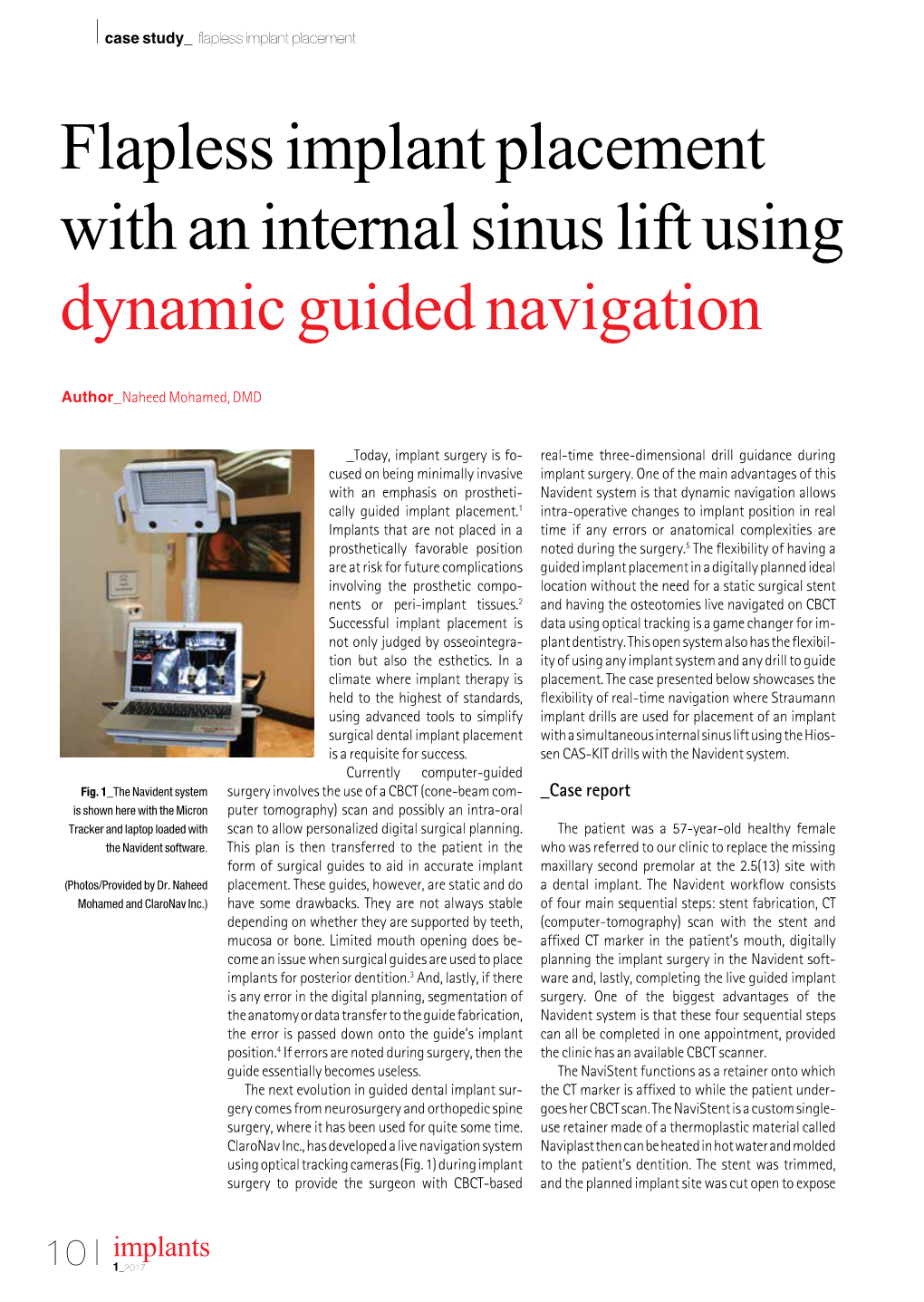 Flapless Implant Placement with an Internal Sinus Lift Using Dynamic Guided Navigation