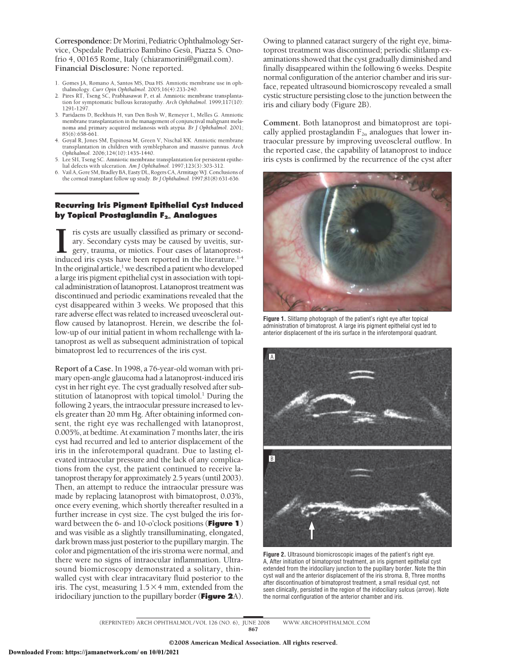 Recurring Iris Pigment Epithelial Cyst Induced by Topical Prostaglandin