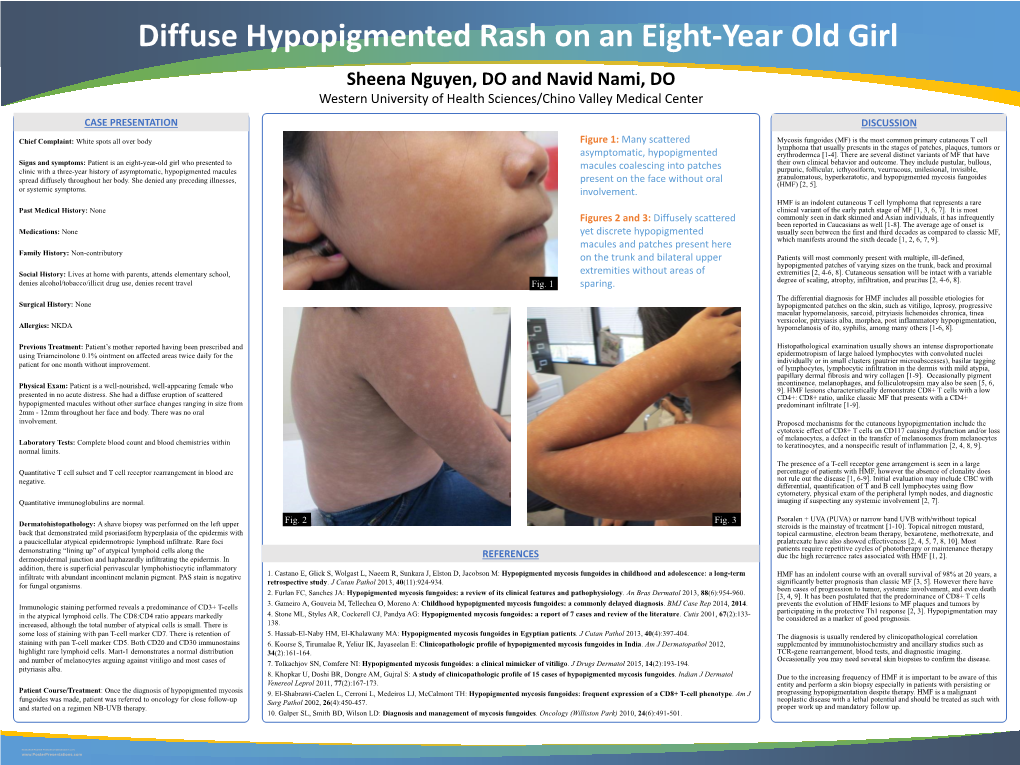 Hypopigmented Mycosis Fungoides Present on the Face Without Oral (HMF) [2, 5]