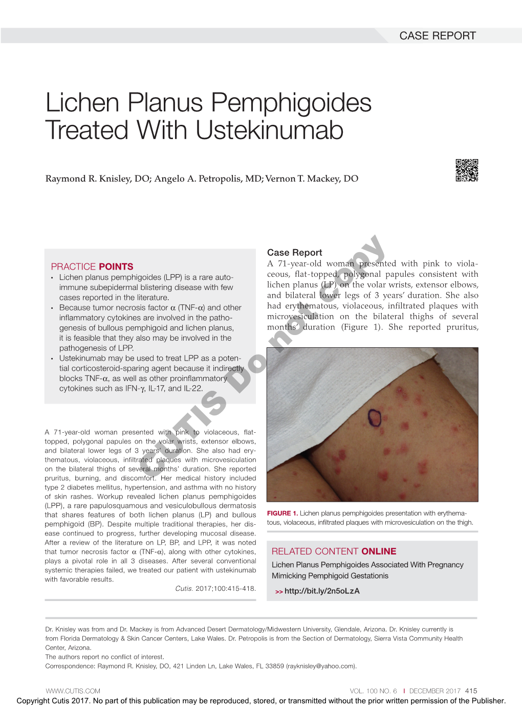 Lichen Planus Pemphigoides Treated with Ustekinumab