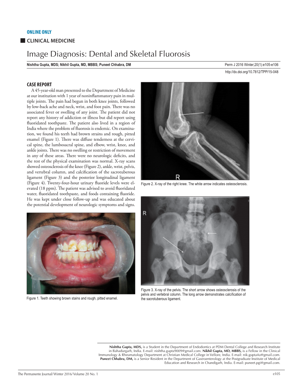 Image Diagnosis: Dental and Skeletal Fluorosis