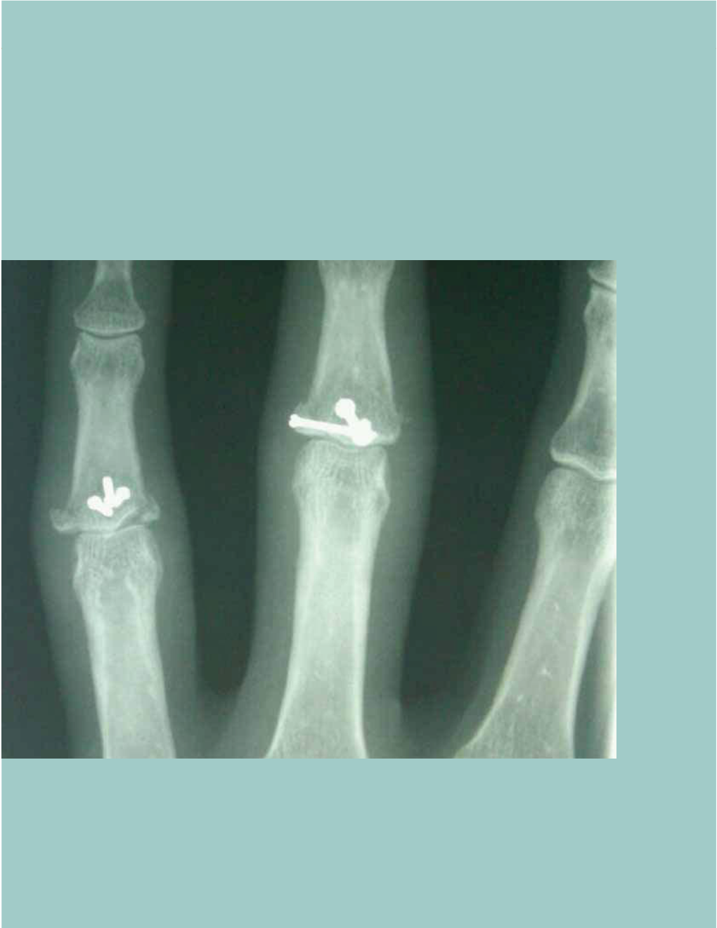 Open Reduction Internal Fixation: Proximal Interphalangeal Facture and Dislocation of the Fingers