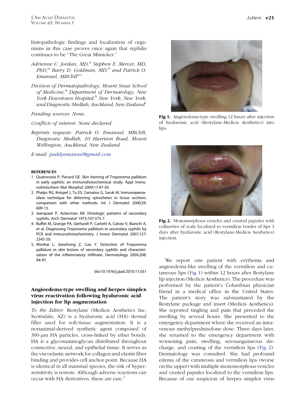 Angioedema-Type Swelling and Herpes Simplex Virus Reactivation Following Hyaluronic Acid Injection for Lip Augmentation