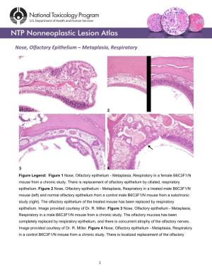 Nose, Olfactory Epithelium – Metaplasia, Respiratory