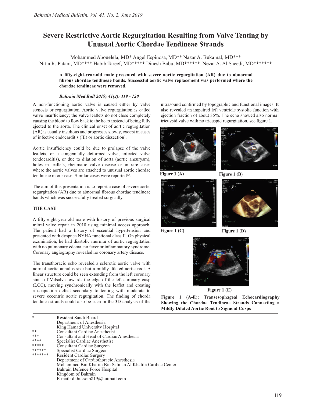 Severe Restrictive Aortic Regurgitation Resulting from Valve Tenting by Unusual Aortic Chordae Tendineae Strands