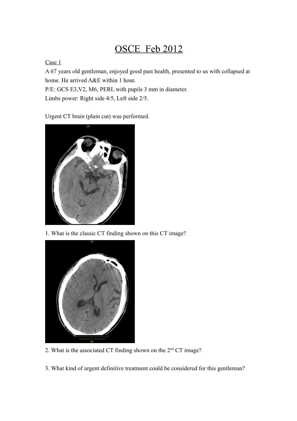 A Dense Middle Artery Sign the First CT Sign of a Thromboembolic MCA Infarct, and Occurs