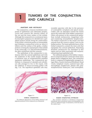 Tumors of the Conjunctiva and Caruncle