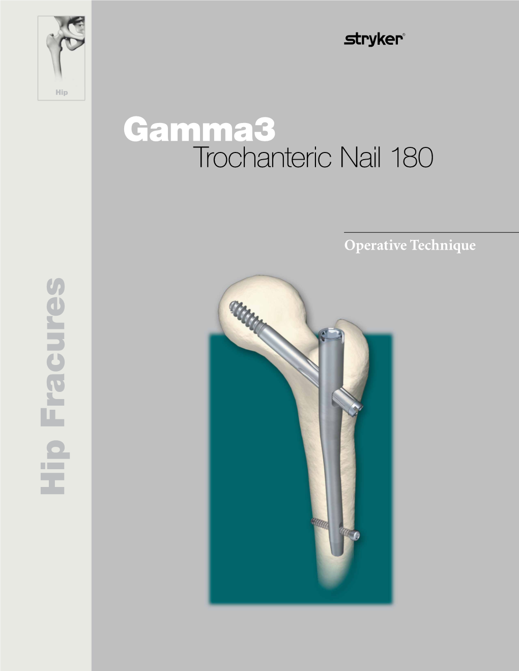 Gamma3 Trochanteric Nail 180