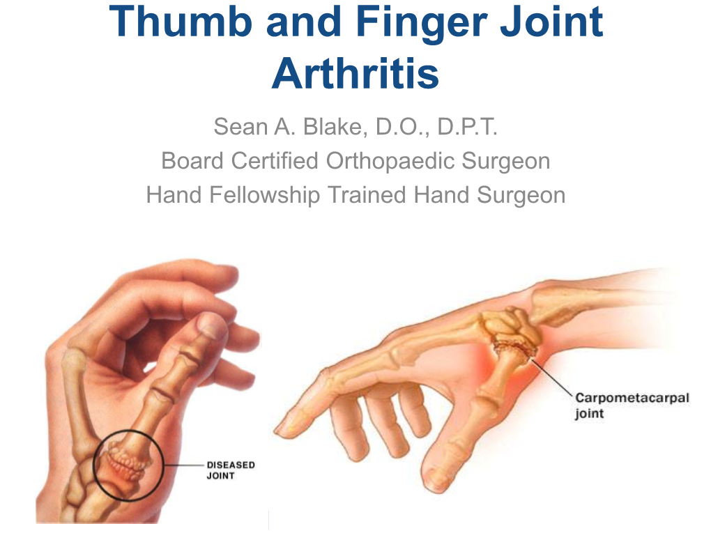 Thumb Basal Joint Arthritis