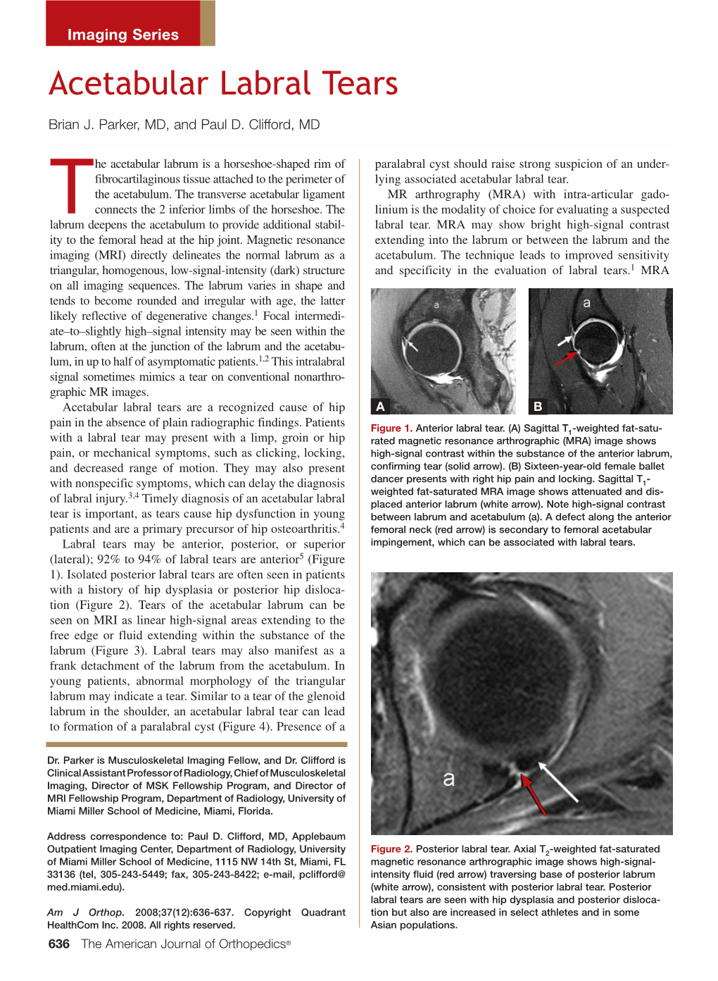 Acetabular Labral Tears