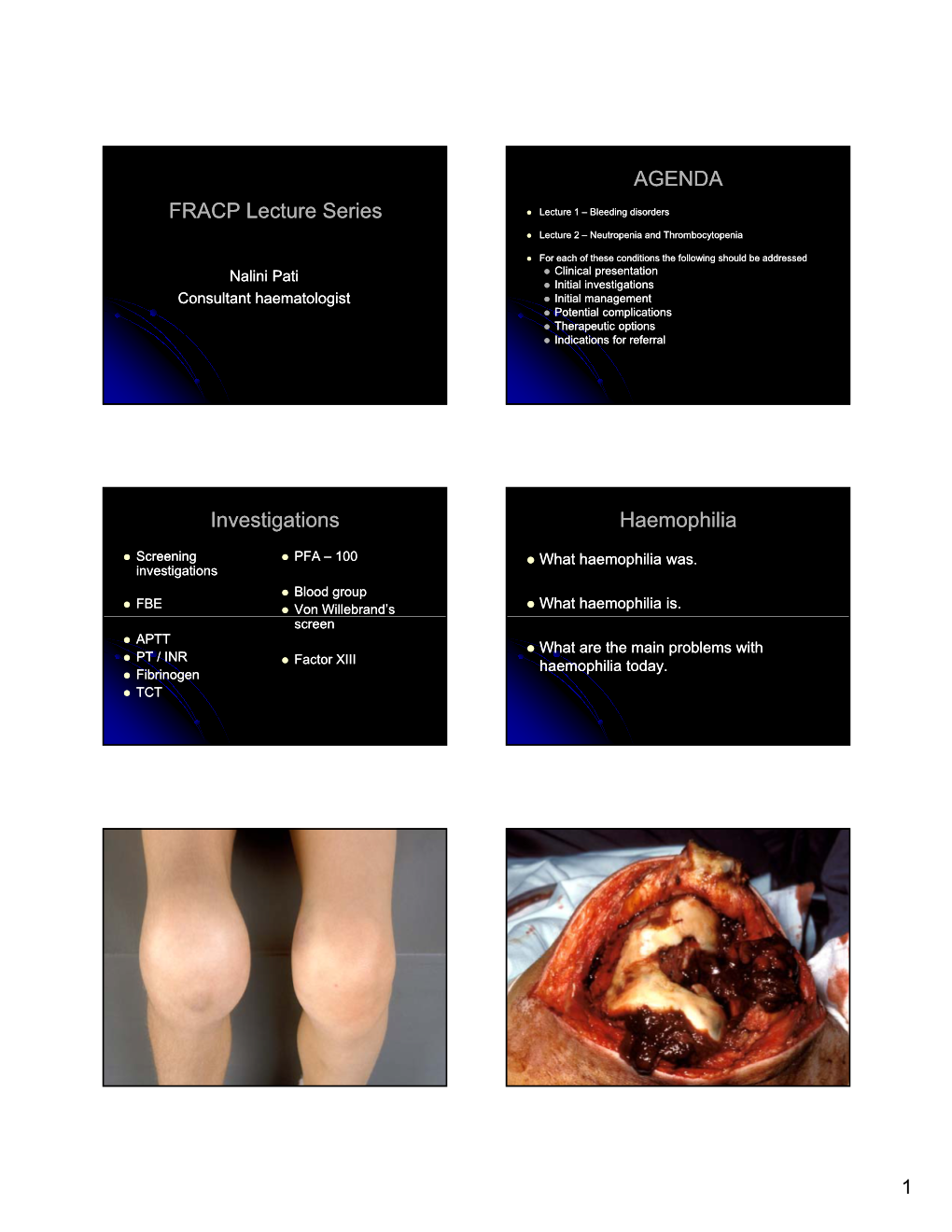 FRACP Lecture Series AGENDA Investigations Haemophilia