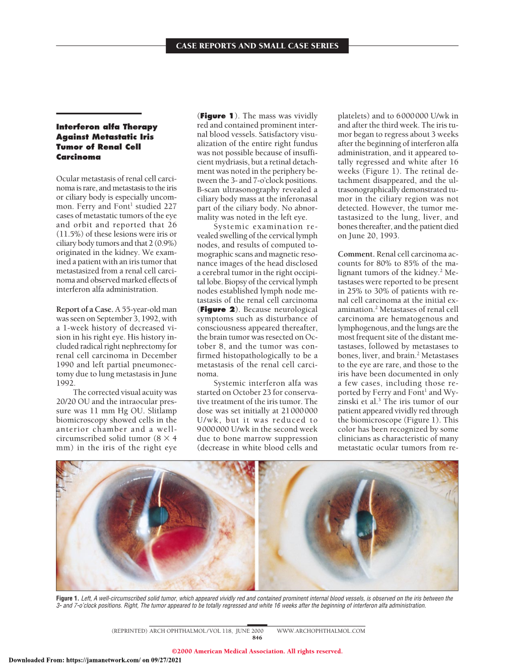 Sutureless Pars Plana Anterior Vitrectomy Through Self-Sealing