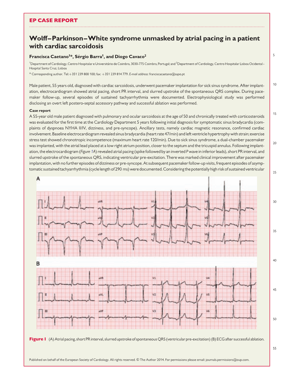 Wolff–Parkinson–White Syndrome Unmasked by Atrial Pacing in A