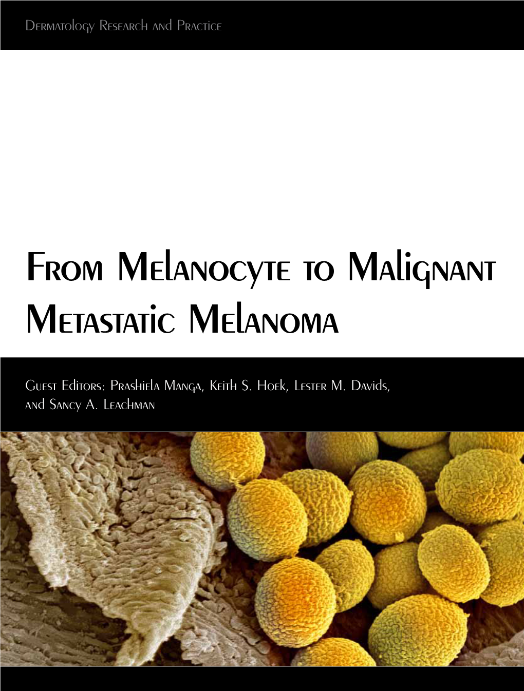 From Melanocyte to Malignant Metastatic Melanoma